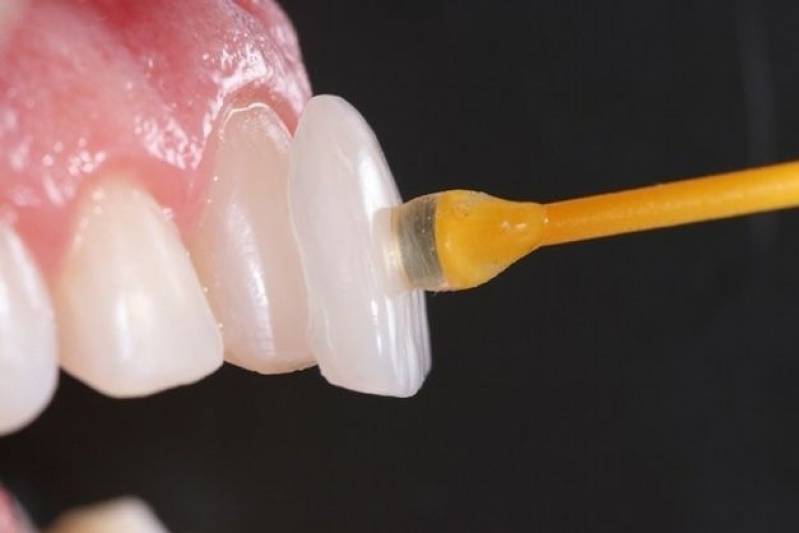 Quanto Custa Faceta Dental de Porcelana na Cerqueira César - Faceta Dental Indireta