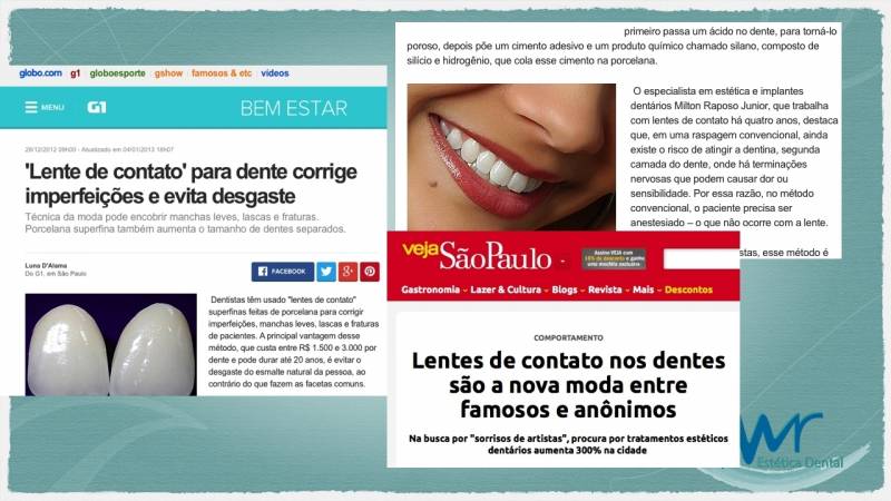 Quanto Custa Faceta Dental na Vila Leopoldina - Faceta Tratamento Dentário