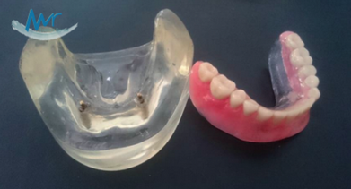 Quanto Custa Implante Dentário de Carga Imediata Jardim Everest - Implante de Dentes