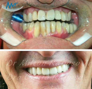 Quanto Custa Implante Dentário de Porcelana na Vila Madalena - Implante Dentário de um Dente