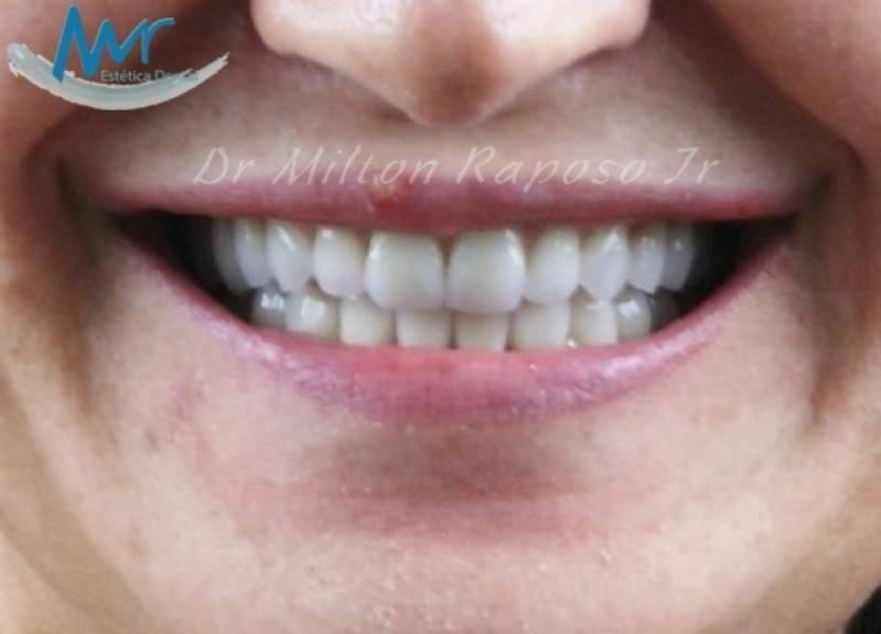 Quanto Custa Tratamento Estético Dentário com Resina em São Domingos - Estética de Implante Dentário