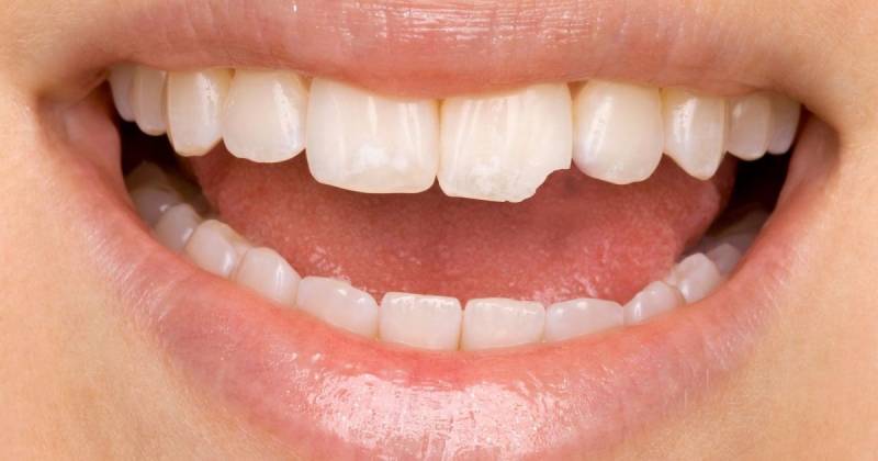Restauração Dentária Bloco Pacaembu - Restauração Dentária para Dente da Frente