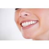 clareamento dental de dentista