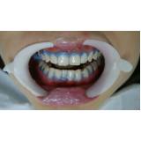 clareamentos dentais de dentista na Água Branca