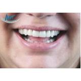 clínica de estética dental para lente dental preço em Pinheiros