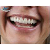 clínica de estética para clareamento dental a laser preço na Freguesia do Ó