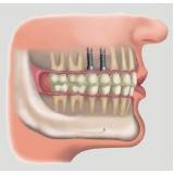 clínica de implante de dentes superiores na Lapa
