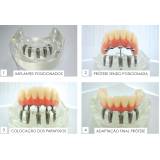clínica de implante dentário dente da frente Bairro do Limão