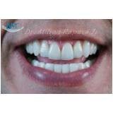 clínica de estética para clareamento dental a laser