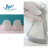 estética dental com dentes separados
