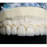 estética dental para implantes na Freguesia do Ó