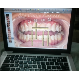 faceta clareamento dental na Pompéia