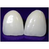 facetas dentais em porcelana na Pompéia