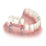 implante de dentes superiores na Água Branca