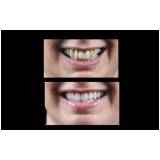 implante dentário de carga imediata preço em Pinheiros