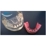 implante dentário de carga imediata na Vila Romana
