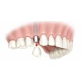 implante dentário de titânio Consolação