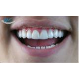 implante dentário de um dente preço Parque Residencial da Lapa