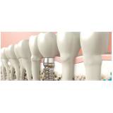 implante dentário dente da frente na Pompéia