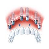 implante dentários dente da frente Alto de Pinheiros