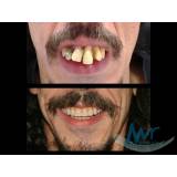 implante dentários Parque Residencial da Lapa
