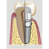 implantes de dentes superiores na Casa Verde