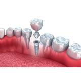 prótese dentária adesiva fixa na Pompéia