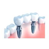 prótese dentária cimentada sobre implante Consolação