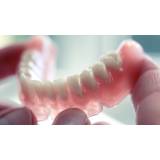 prótese adesiva dentária