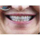 quanto custa tratamento estético para os dentes na Pompéia