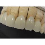 restauração dental em resina preço Consolação