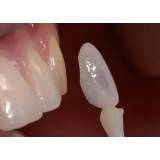 tratamento estético dentário preço em Pinheiros