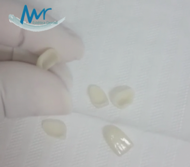 Tratamento Estético Dentário com Resina na Água Branca - Estética de Implante Dentário